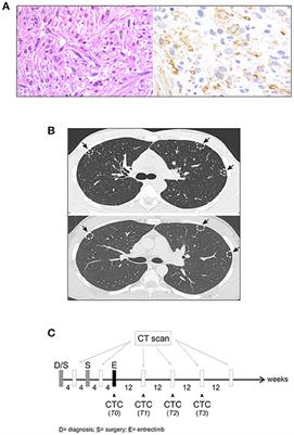 Case Report: Circulating Tumor Cells as a Response Biomarker in ALK-Positive Metastatic Inflammatory Myofibroblastic Tumor